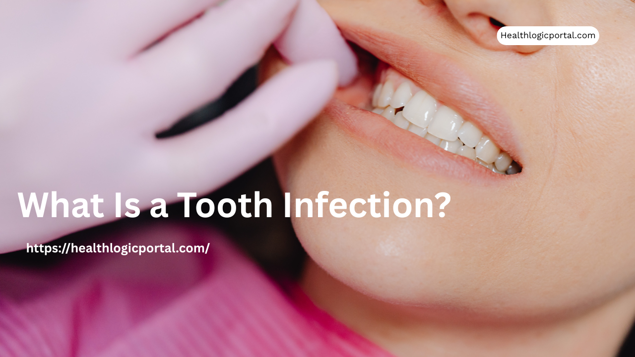 What is a tooth infection – bacteria attacking the pulp and causing dental abscess.