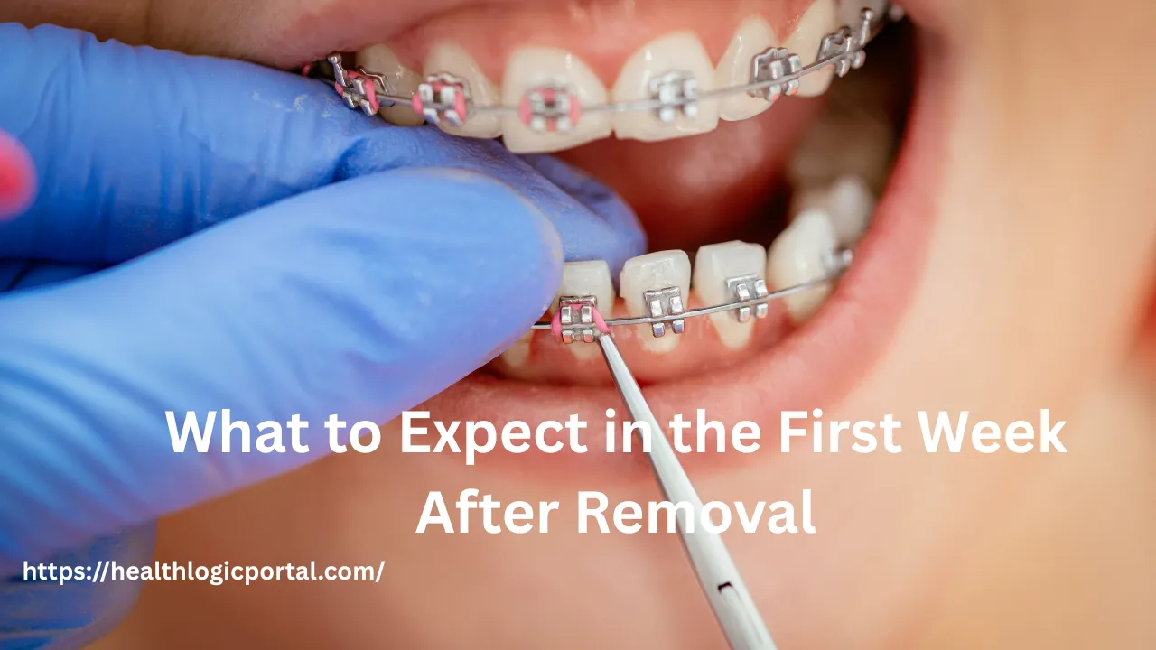 How Long Does It Take To Get Braces Off