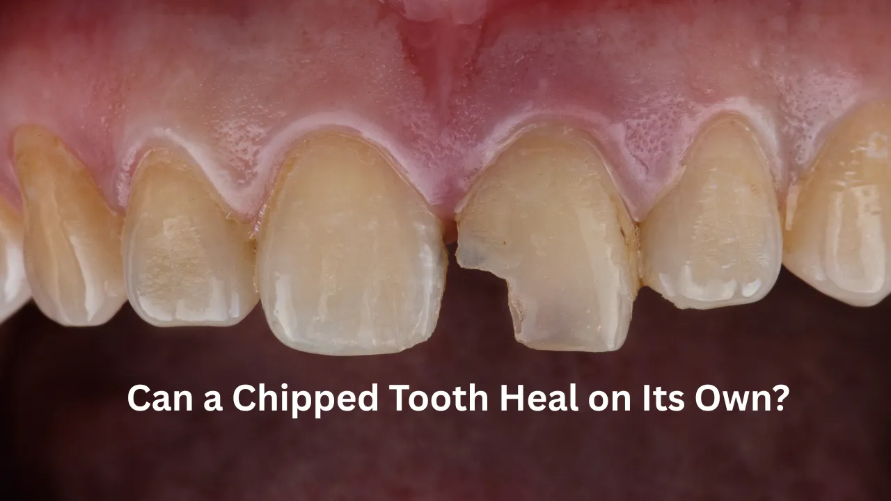 Chipped Tooth